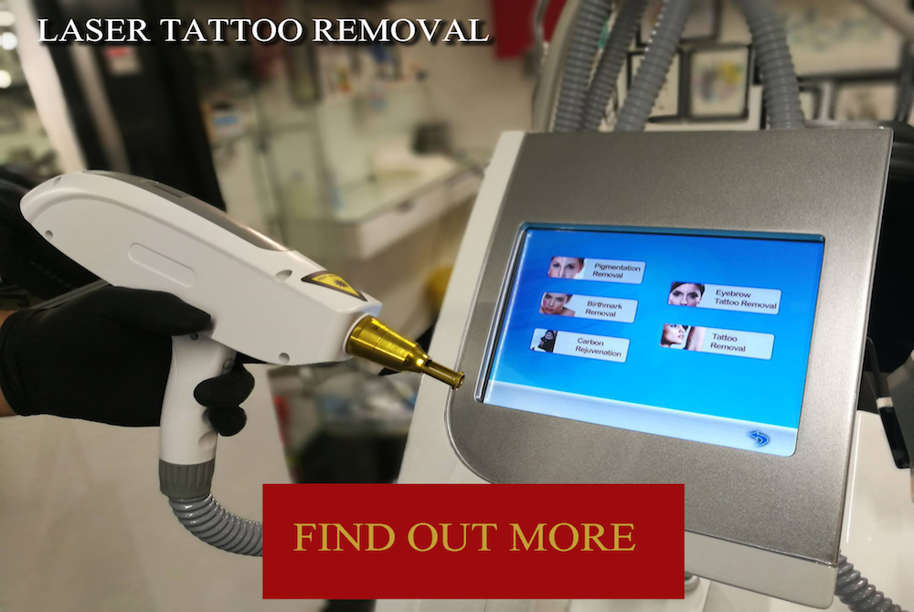 Laser Tattoo Removal, Dublin Laser Tattoo removal