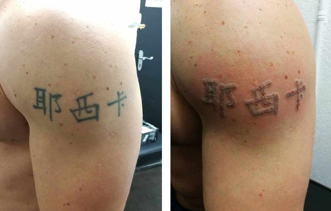 Best Laser tattoo removal in Dublin